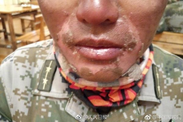 雷霆主帥：亞歷山大的傷勢取得了一些進展